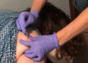 Dry Needling Technique